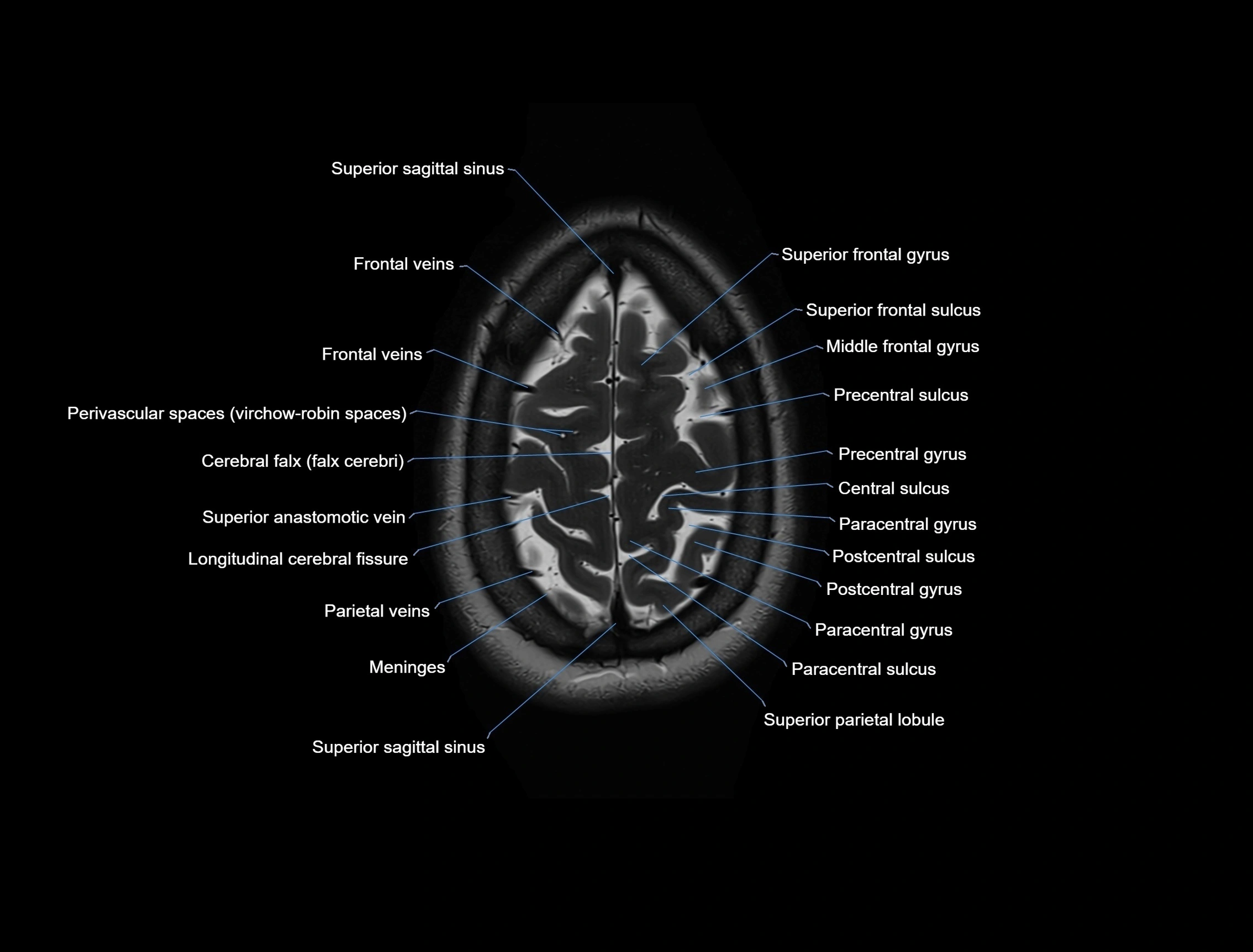 MRI Brain axial cross sectional radiology anatomy 3T image  -img-00001-00053.webp